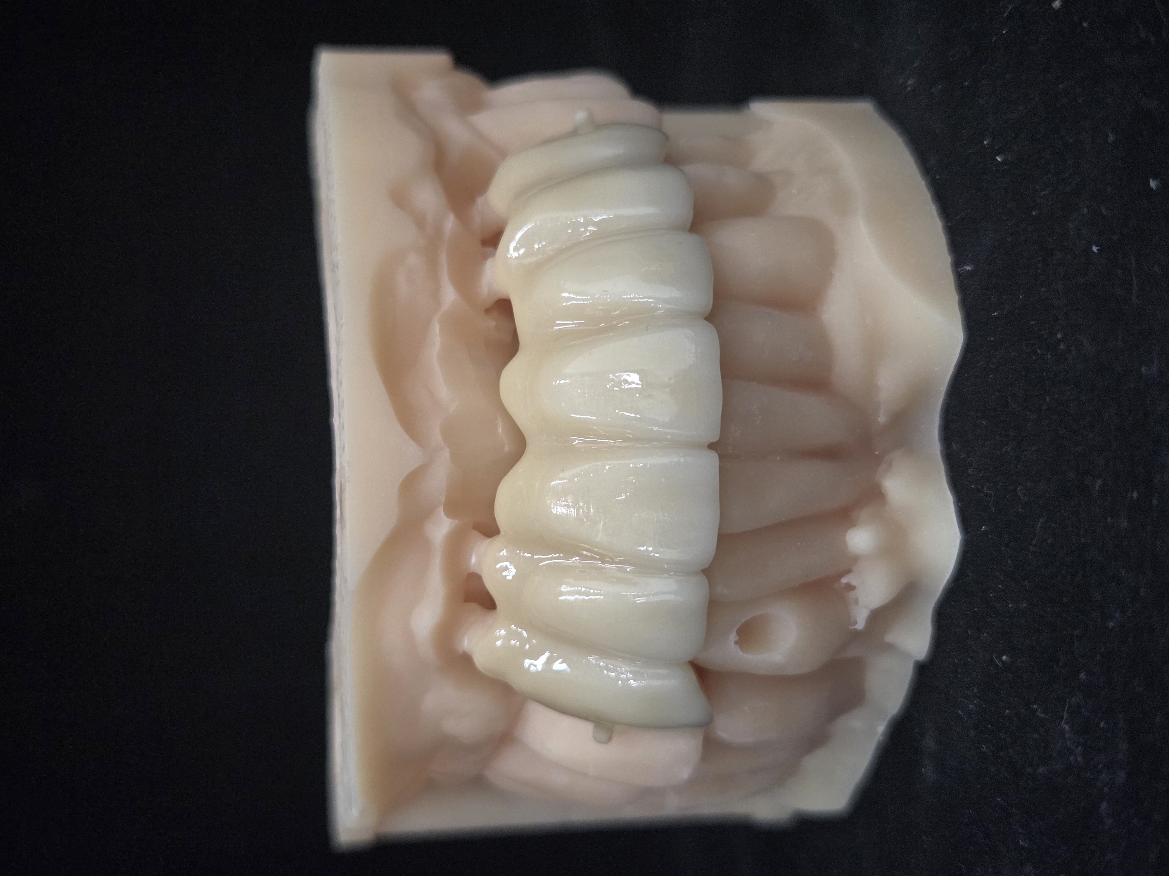 지르코니아 브릿지